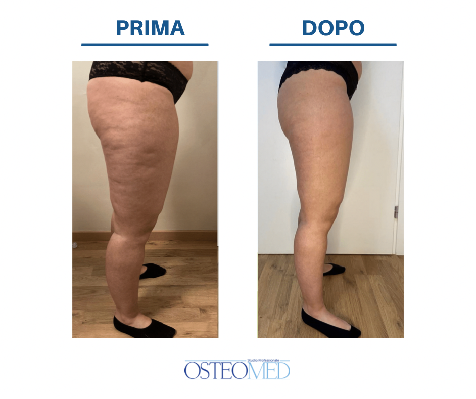 Cellulite Cose E Come Trattarla Clinicare